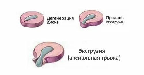 Дорзальной экструзии l5 s1 диска что это. Экструзия диска позвоночника l5-s1. дорзальная экструзия l5s1 диска что это такое. экструзия диска l5-s1 9мм. экструзия межпозвонкового диска l4-l5.