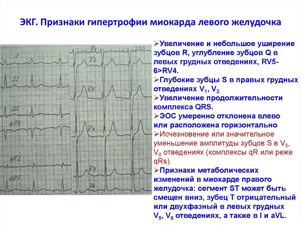 Диффузные изменения экг что это значит. Изменения на ЭКГ при гипертрофии левого желудочка. Гипертрофия миокарда левого желудочка на ЭКГ. ЭКГ-признаки гипертрофии миокарда желудочков. ЭКГ-изменения при гипертрофиях миокарда..