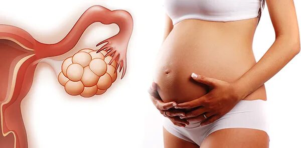 Поликистоз и беременность. Беременность при поликистозе яичников. Поликистозные яичники и беременность.