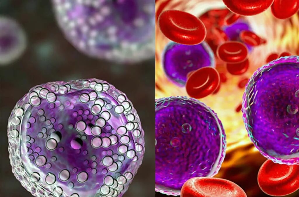 Leukemia. Types of leukemia.