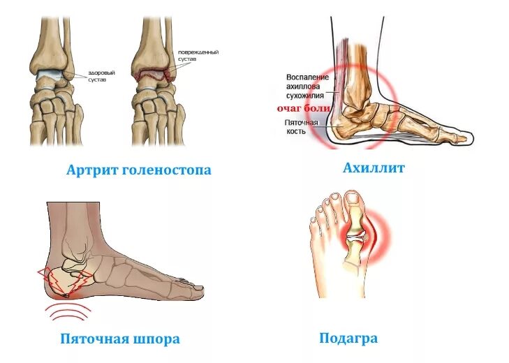 Подагра на суставе голеностопа. Болит голеностоп спереди. Артрит плюснефалангового сустава стопы.