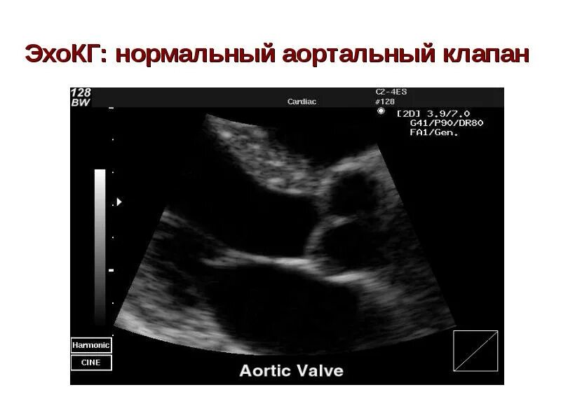 Хорды митрального клапана. Трикуспидальный клапан сердца узи. Створки митрального клапана на узи сердца. Аортальная недостаточность эхокардиография. Узи сердца пролапс митрального клапана.