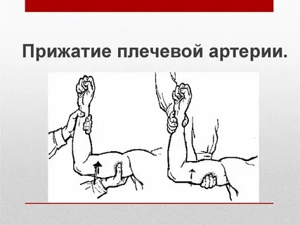 Кровотечение из плечевой артерии