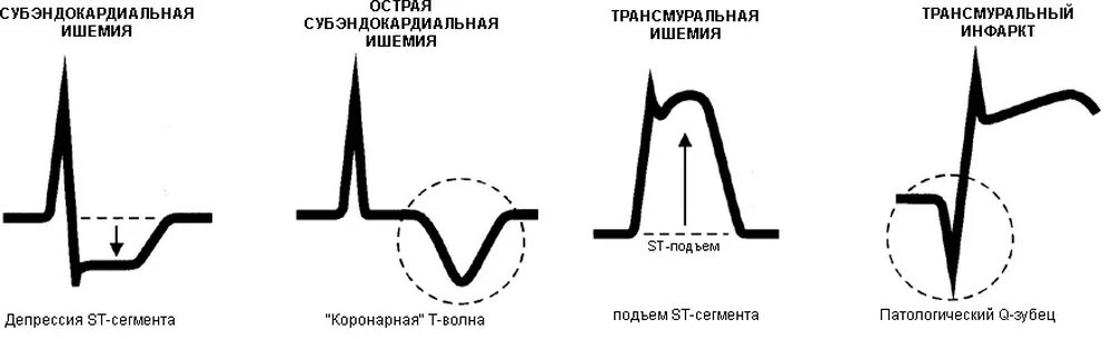 Трансмуральный инфаркт на ЭКГ признаки. ЭКГ при трансмуральной ишемии миокарда. ЭКГ при ишемии повреждении и инфаркте миокарда. ЭКГ при ишемическом повреждении миокарда.