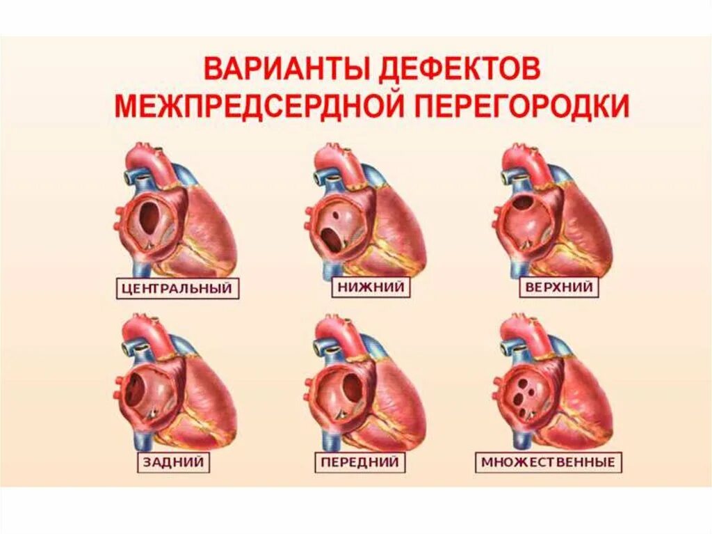 Вторичный дефект межпредсердной перегородки у детей. Врожденный порок сердца дефект межпредсердной перегородки. Анатомия межпредсердной перегородки. Врожденный порок сердца ДМПП.