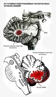 Инсульт мозжечка последствия