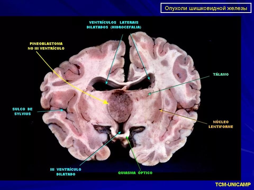 Шишковидная железа опухоль. Кальцинация шишковидной железы. Шишковидная железа опухоль. Эпифиз функции кратко. Шишковидная железа опухоль.