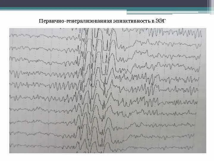 Диффузные эпилептиформные. Эпилептиформная активность на ЭЭГ. Электроэнцефалография патология. Эпилептический статус ЭЭГ. Мультифокальная эпилепсия ЭЭГ.