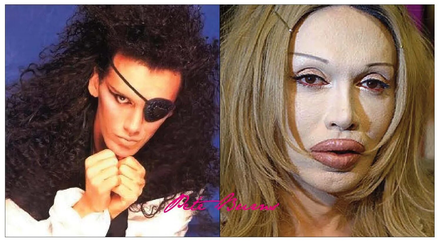 Пит бёрнс. Пластическая операция пила. Пит бёрнс в молодости до операций. Пит бёрнс. Пит бёрнс.