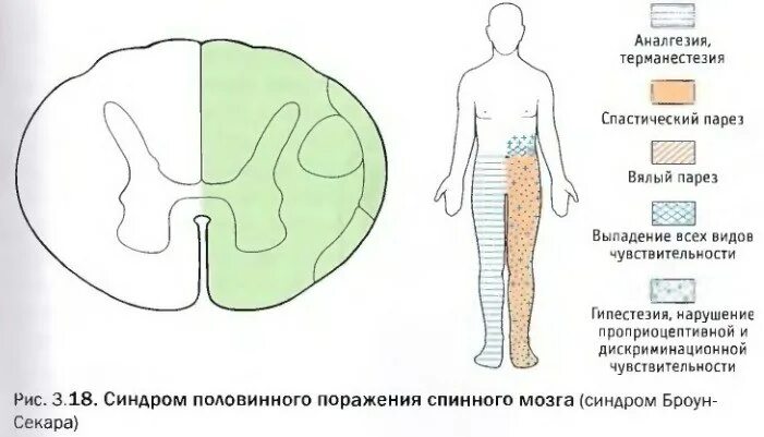 Поражение половины мозга. Синдром при поражении половины поперечника спинного мозга. Синдром половинного поражения спинного мозга неврология. Синдром половинного поражения спинного мозга (синдром Броун-Секара).. Поражения половины поперечника спинного мозга (синдром Броун-Секара).