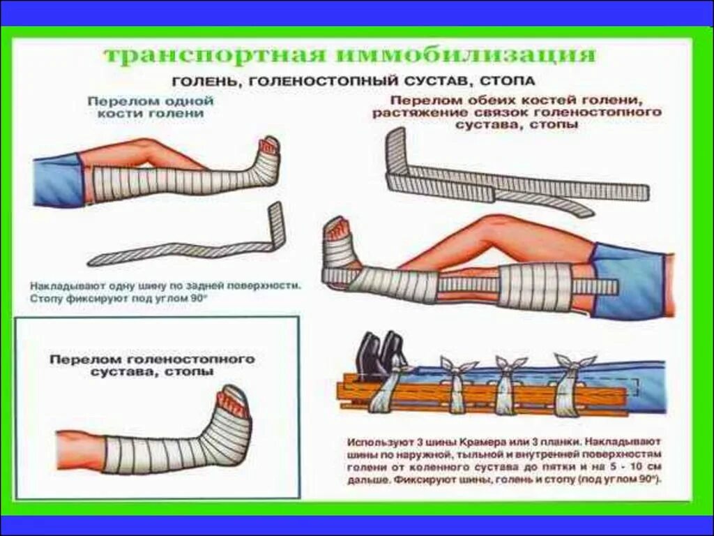 Кровотечение при открытом переломе голени. Техника наложения шин при переломах костей. Транспортировка пострадавшего при переломе голени. Шина Крамера для иммобилизации пострадавшего с переломом бедра. Перелом конечностей иммобилизация.