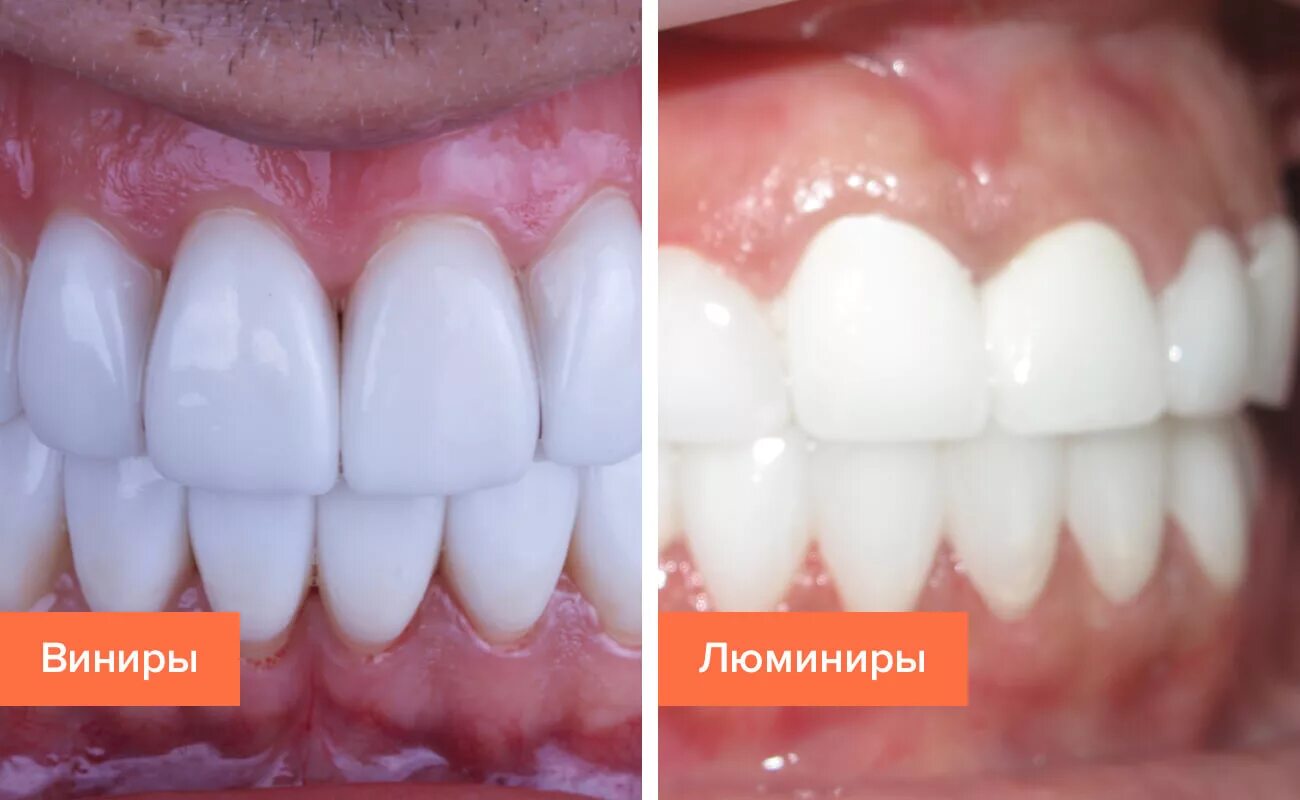 Виниры зачем. Композитные виниры улыбка. Виниры люминиры ультраниры компониры. Виниры-элайнеры snap-on smile. Голливудская улыбка люминиры.