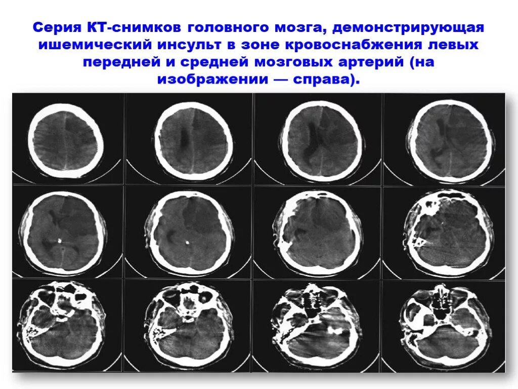 Геморрагический инсульт и ишемический инсульт кт. Ишемический инсульт мрт. Геморрагический инсульт головного мозга кт. Ишемический инсульт снимок кт. Инсульт 2 степени