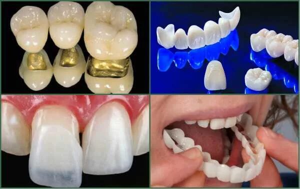 Коронки из каких материалов бывают. Стоматологические коронки. Сапфировые коронки на зубы. Форма зубов для зубных коронок.