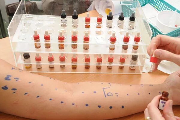 Скарификационные аллергопробы. Капельные кожные аллергопробы. Кожно тестирование аллергопроьы. Тест на аллергены (аллергопробы).