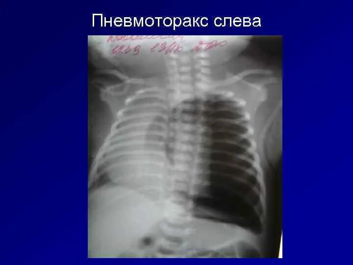Пневмоторакс у новорожденных