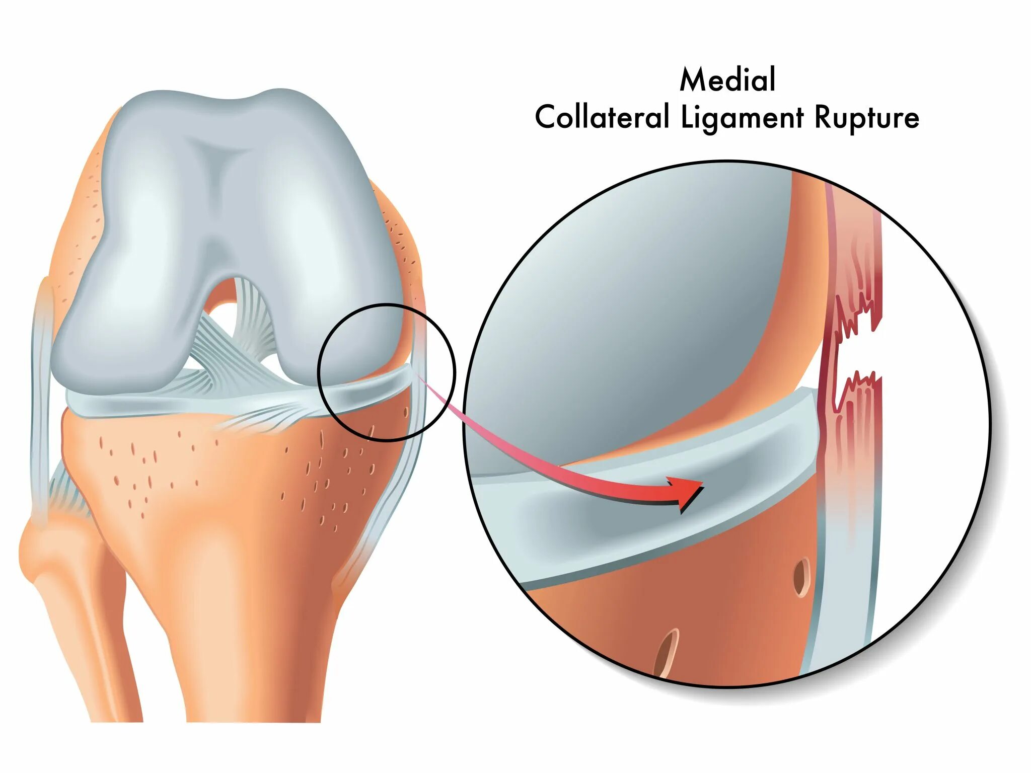 Разрыв медиальной. Повреждение связок мениска. Повреждение медиальной коллатеральной связки. Растяжение мениска сустава.