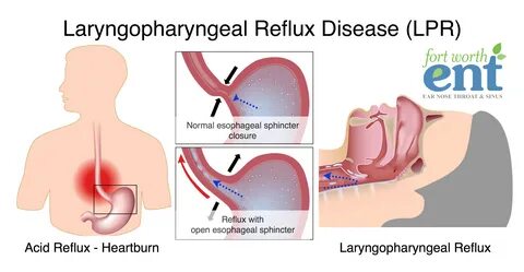 acid reflux throat pain - muzeumtara.ru.