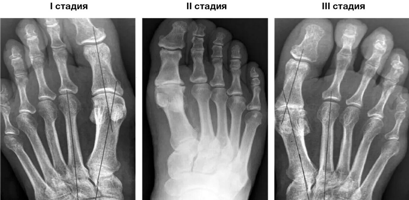 Плюснефаланговый артрит