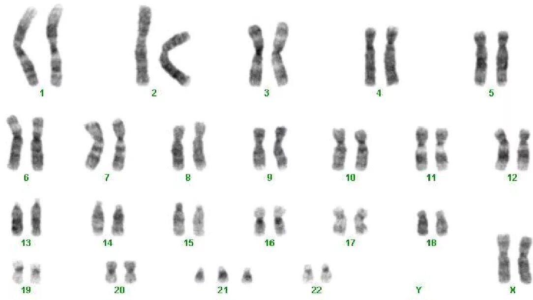 Синдром Дауна 21 хромосома. Патологии кариотипа. 47 XYY кариотип. Трисомия по 21 хромосоме. Лишняя 21 хромосома