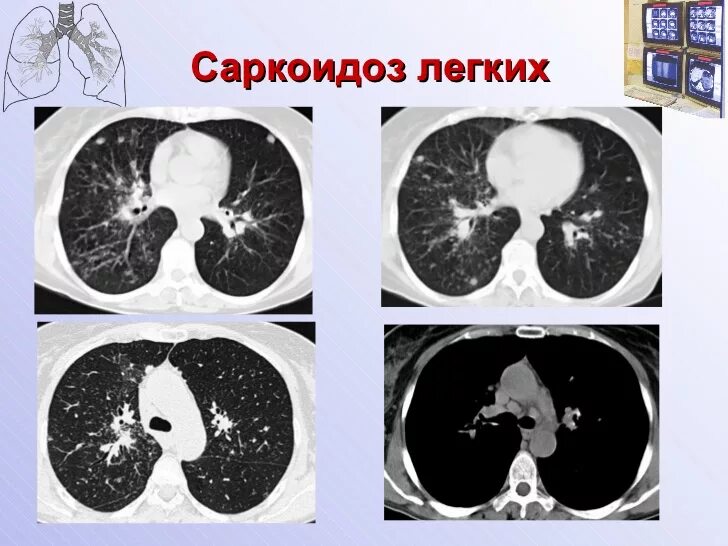 Дерева в почках в легких кт. Саркоидоз легочно-медиастинальная форма на кт. Саркоидоз кт картина. Саркоидоз легких кт картина.