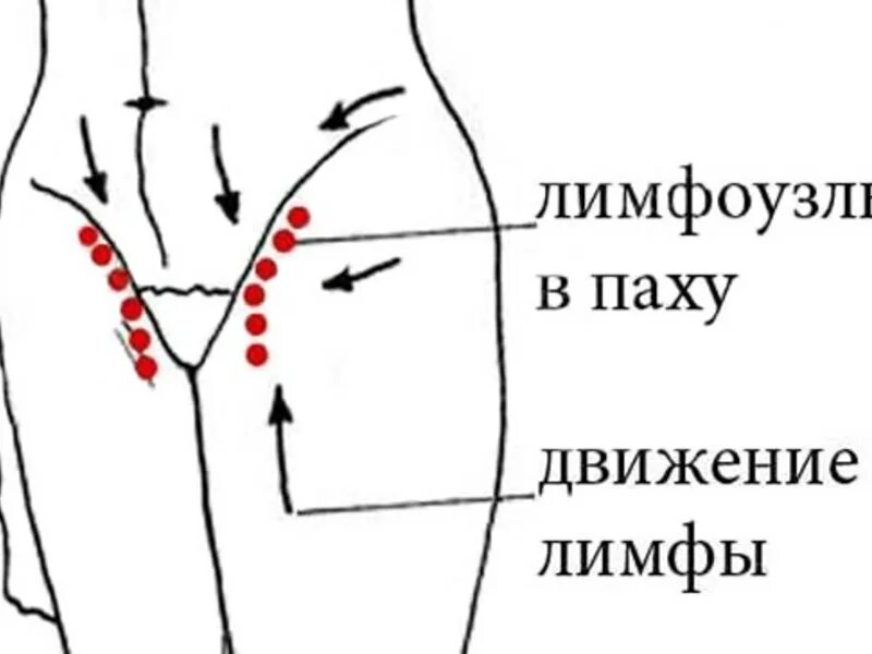 Лимфоузлы в паху у женщин где находятся схема. Где расположены паховые лимфоузлы. Расположение лимфоузлов у женщин в паховой области. Где у человека находятся паховые лимфоузлы. Боли в правой области паха