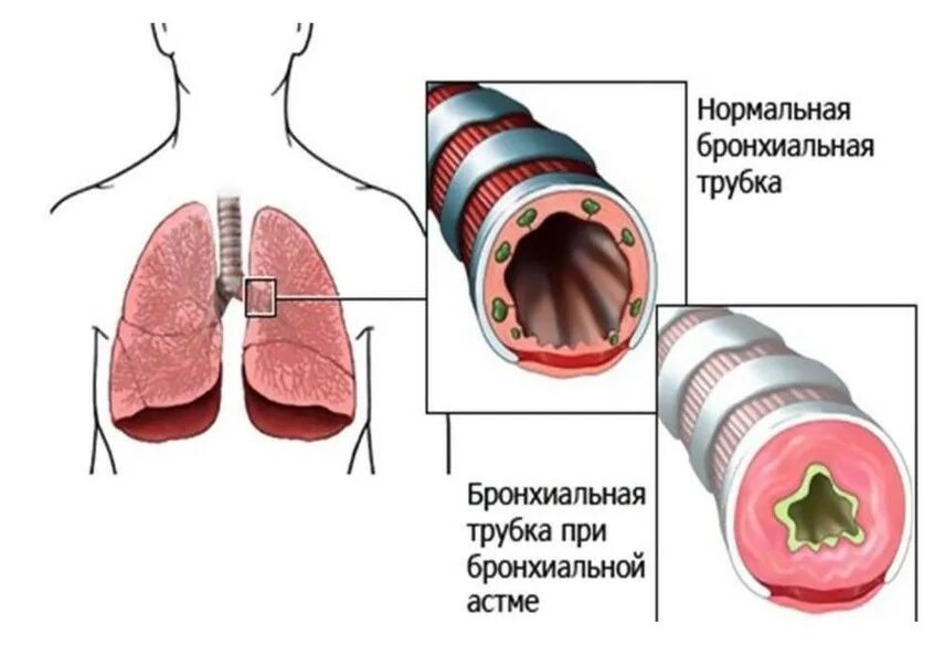 бронхит заразен или нет для детей