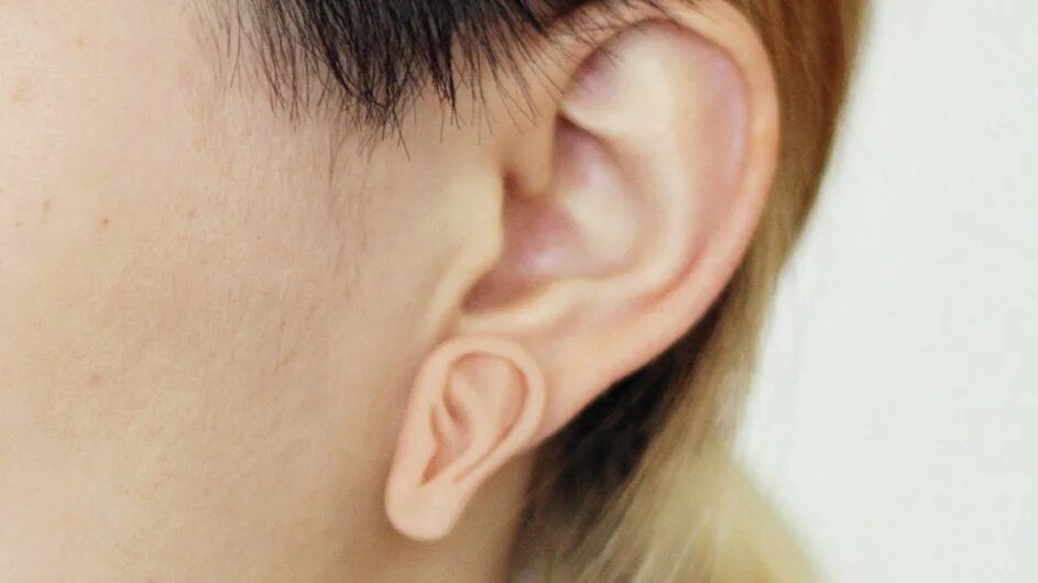 Почему уши разные. Морщины на ушных мочках ушей.