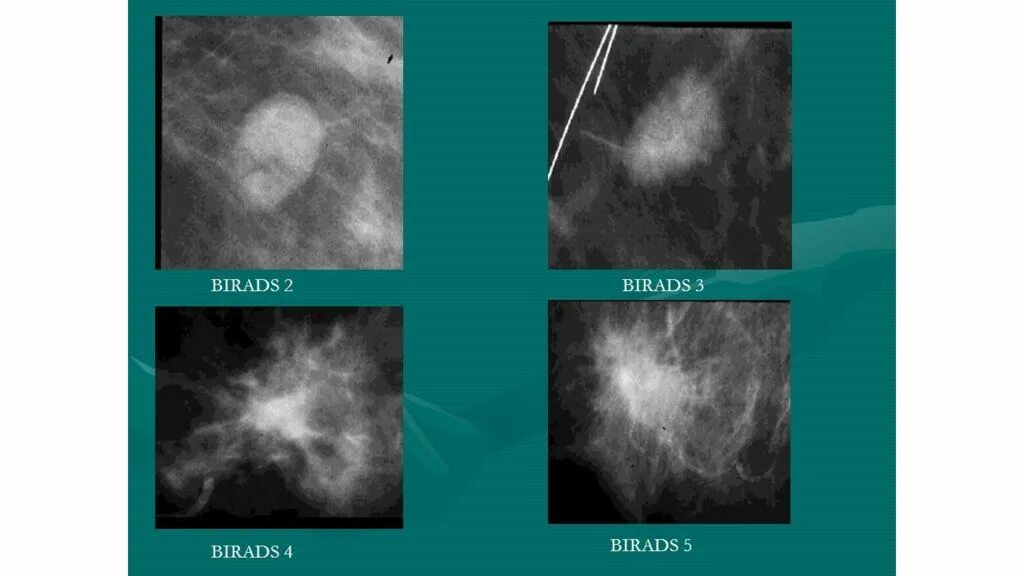 Категория bi rads 2 молочных желез. Маммография bi-rads 2. Bi-rads 3 молочной железы маммограмма. Классификация bi-rads молочных желез. Фиброзно кистозная мастопатия молочной железы bi-rads-4a.