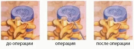 Операции лазером грыжа