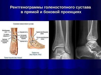 Стопа человека перелом