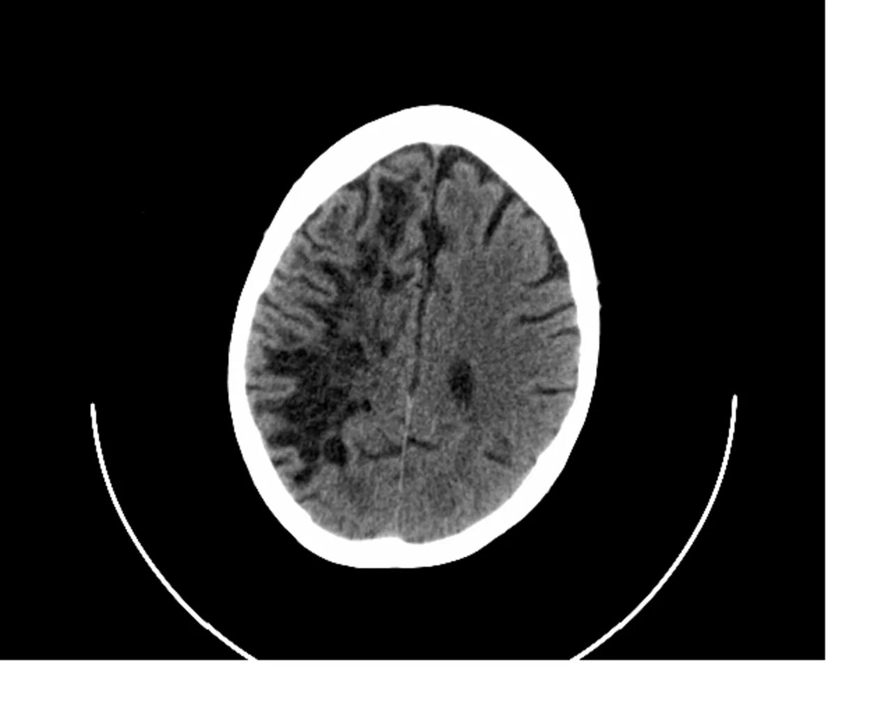 Расширенные периваскулярные пространства вирхова-робина на мрт. Расширение пространств вирхова-робина кт. Периваскулярные пространства мрт. Расширение периваскулярных пространств вирхова-робина. Криптококкоз головного мозга мрт.