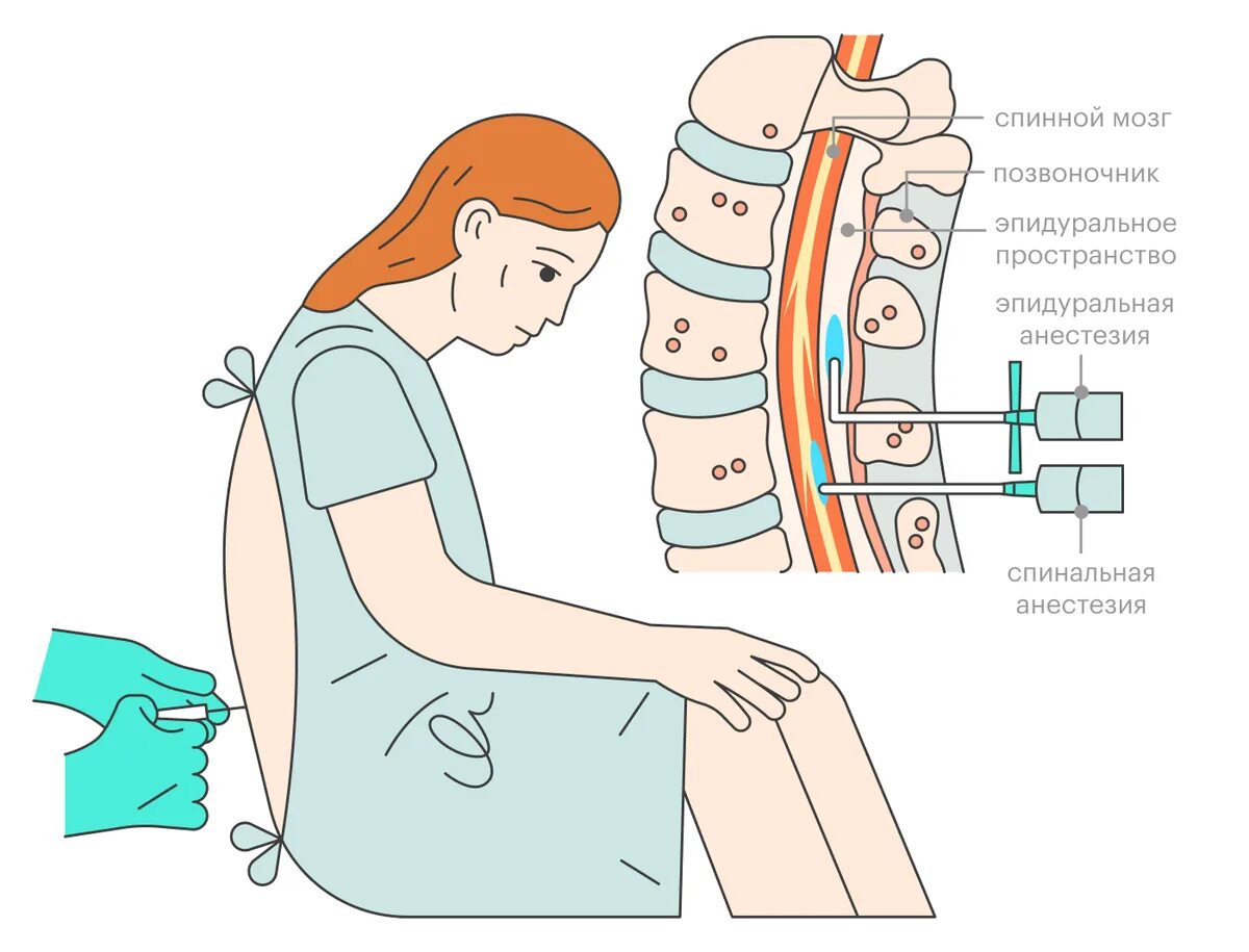 Эпидуральная спинная. Люмбальная эпидуральная анестезия. Эпидуральная анестезия хирургия. Спинальная и эпидуральная анестезия. Эпидуральная анестезия анестетик.