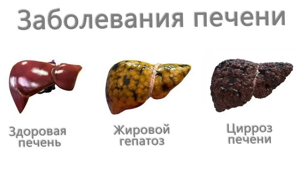 Желчный ожирение