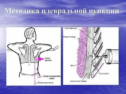 Плевральная пункция