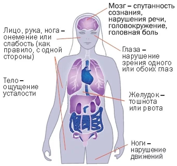 Слабость в организме. Онемение одной половины тела. Млеет левая сторона тела. Инсульт симптомы у женщин левая сторона тела. Слабость руки симптом