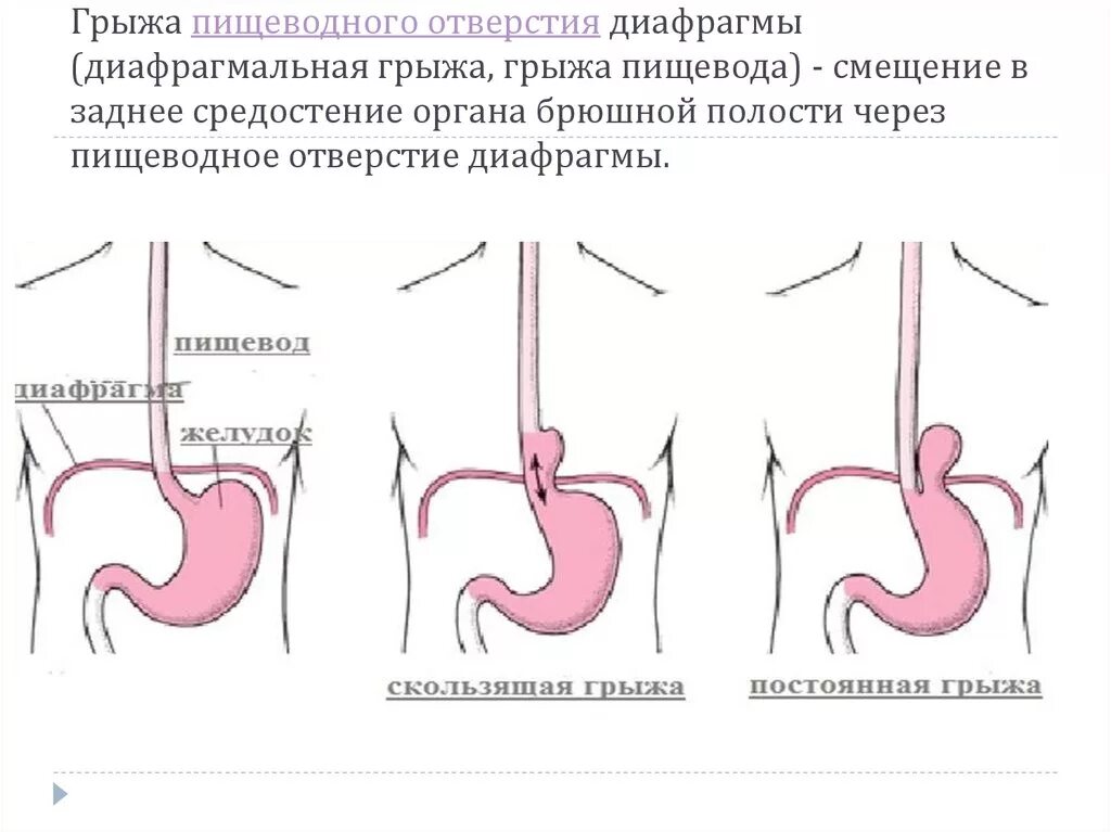 Симптомы грыжи желудка пищевода. Скользящая грыжа пищевода. аксиальная скользящая грыжа пищеводного отверстия. скользящая хиатальная грыжа. парастернальная грыжа диафрагмы.