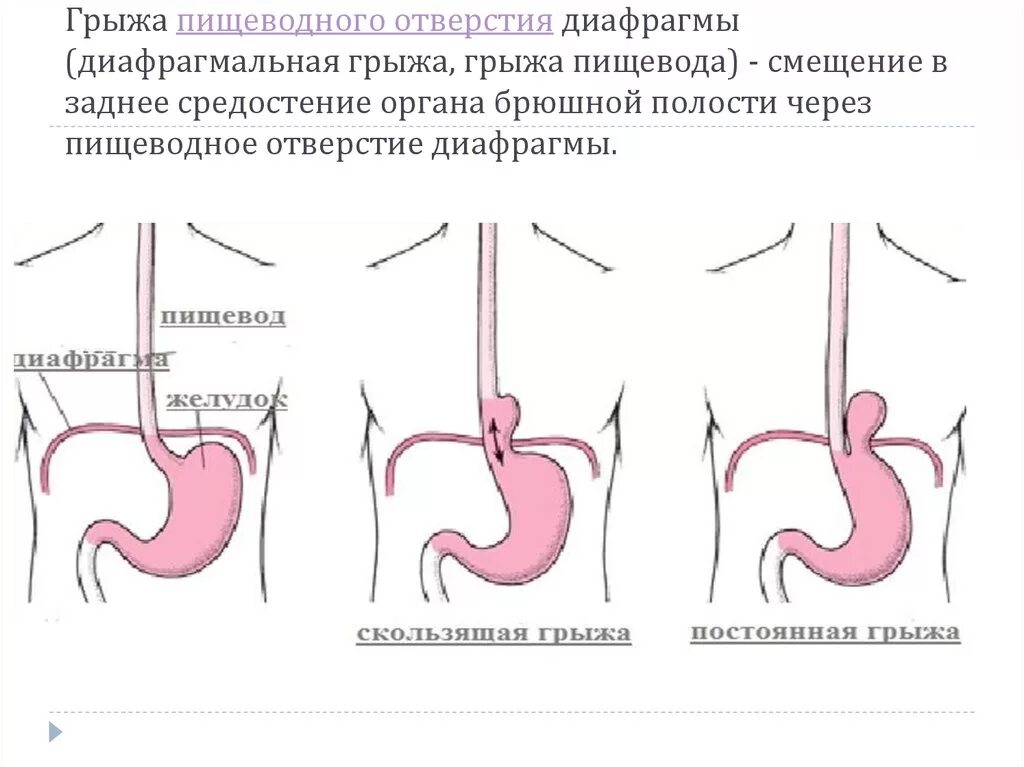 Став пищевода. Аксиальная скользящая грыжа пищеводного отверстия. Фундальная грыжа пищеводного отверстия. Парастернальная грыжа диафрагмы. Скользящая аксиальная грыжа пищеводного отверстия 2 степени.