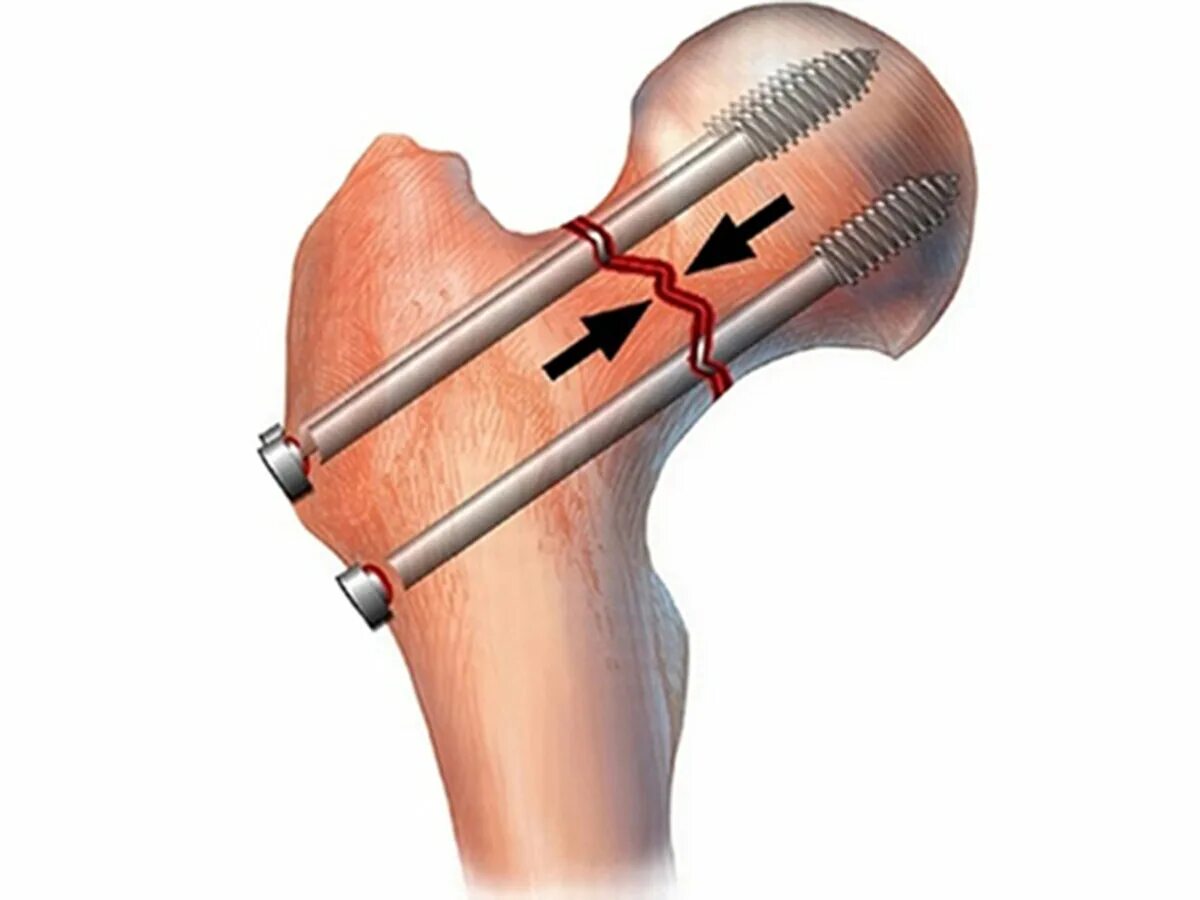 Остеосинтез перелома бедренной кости. Остеосинтез перелома шейки бедра канюлированными винтами. Перелом шейки бедра остеосинтез. Остеосинтез шейки бедренной кости винтами. Трещина шейки бедра