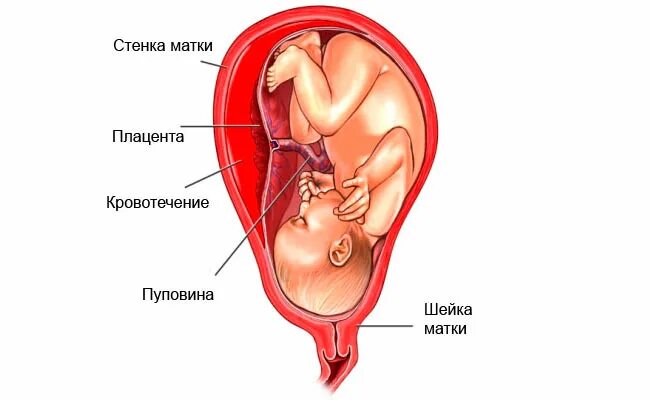 Плацента на рубце матки. Отслойка плаценты кровотечение. Ретроплацентарная отслойка плаценты.