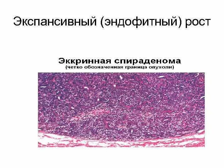 Экзофитный и эндофитный рост опухоли. Экзофитный экспансивный рост. Эндофитный Тип роста опухоли. Экспансивный рост это