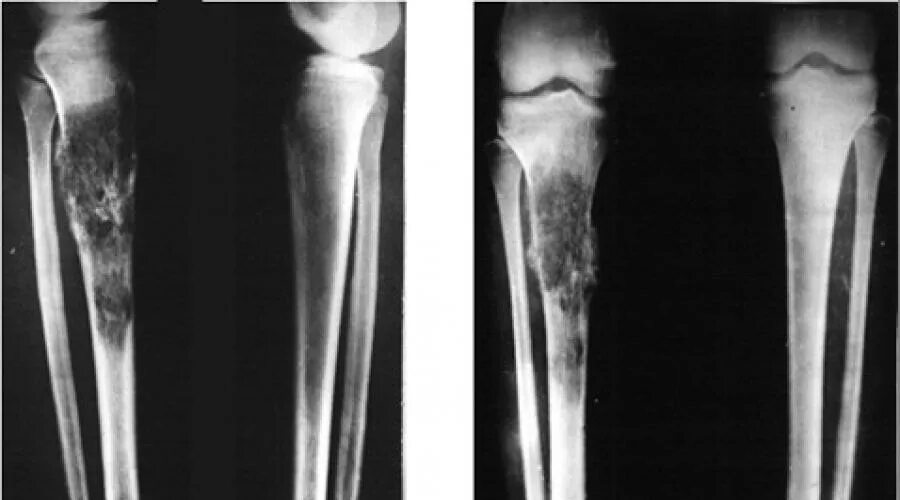 Рак в костях прогноз. Остеосаркома большеберцовой кости. Остеогенная саркома бедренной кости рентген. Ретикулосаркома кости. Хондробластома большеберцовой кости.