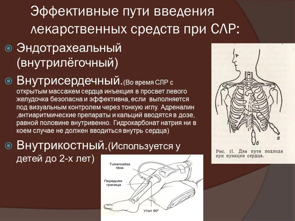 Адреналиновый укол. Введение препаратов при СЛР. Внутрисердечное Введение лекарственных средств при СЛР. Пути введения лекарственных препаратов при СЛР. Пути введения адреналина при проведении СЛР.