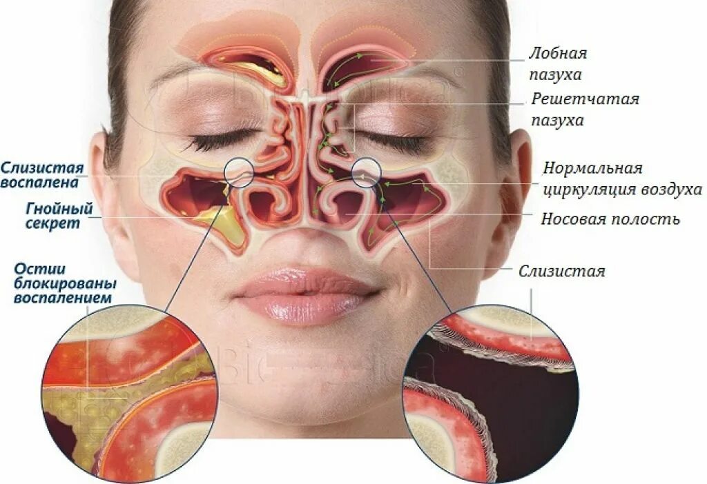 Гайморовы пазухи гайморит. Носовая пазуха и гайморова пазуха. Носовые пазухи строение гайморит. Гнойный н