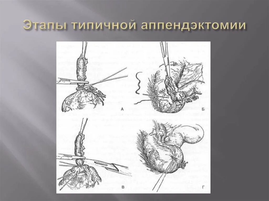 Антенградная ретроградный аппендоктомия. Ретроградная аппендэктомия. Антеградная аппендэктомия этапы. Ретроградная аппендэктомия этапы.