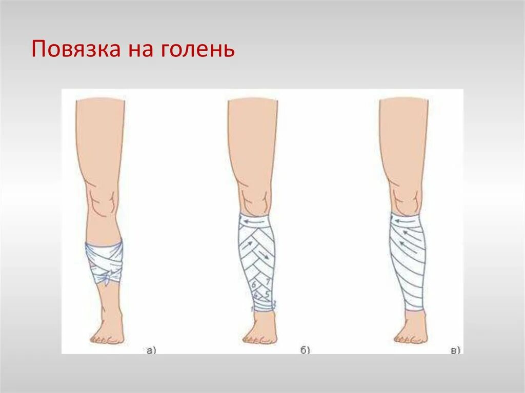 Повязка на голень десмургия. Колосовидная повязка на голень. Повязка на стопу десмургия. Наложение асептической повязки на голень и стопу. Эластичное бинтование ноги