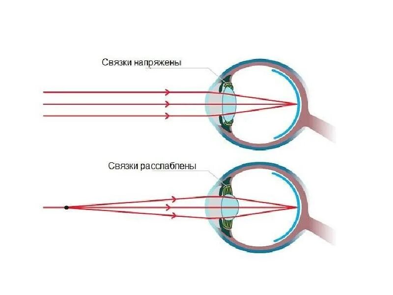 Аккомодация рисунок. Схема аккомодации хрусталика. Аккомодация зрения схема. Структура аккомодации глаза. Аккомодация механизм в офтальмологии.