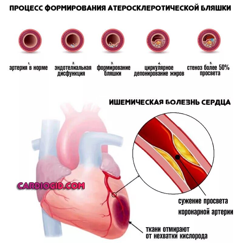 Ишемическая болезнь сердца стадия 5 степени. Степени атеросклероза венечных артерий. Атеросклероз ИБС стенокардия инфаркт. Атеросклероз коронарных сосудов симптомы.