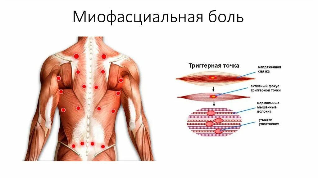 Синдром боли в спине. Миофасциальный болевой синдром триггерные точки. Миофасциальный болевой синдром спины. Триггерные точки в мышцах спины. Мышцы спины триггерные точки человека анатомия.