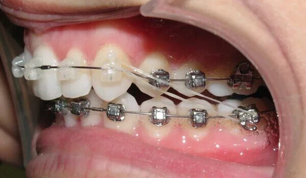 резинки для исправления прикуса